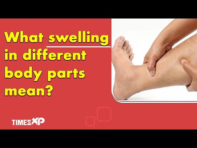 Swelling in different areas of body can indicate underlying health issues | Edema Causes | TimesXP
