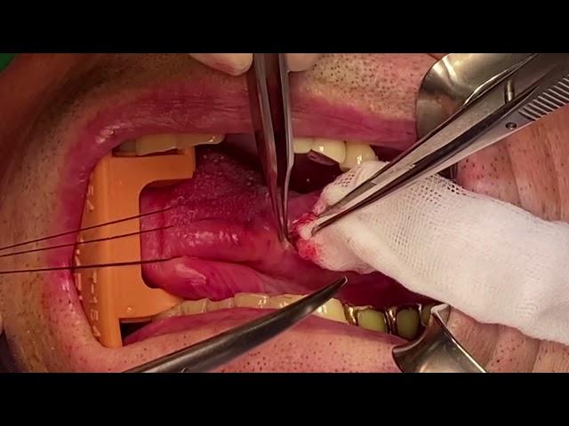 Schwannoma on lateral border of tongue