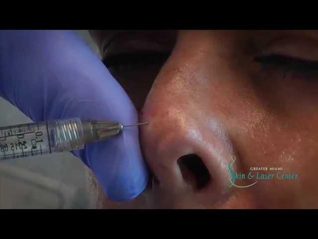 Correcting a non traumatic defect on the tip of the nose.