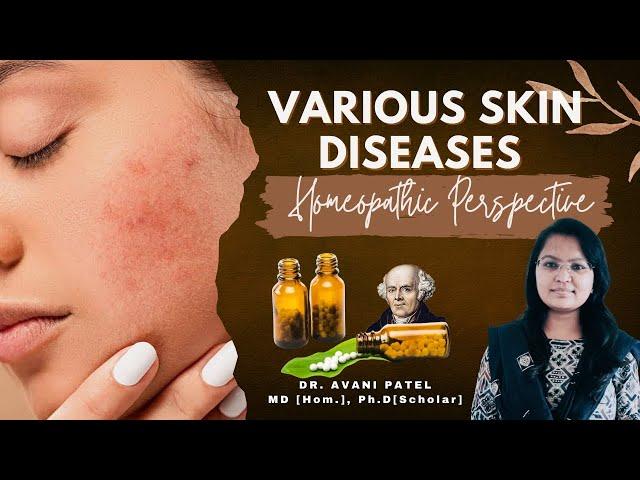 Various Skin Diseases & Homeopathy I Dr. Avani Patel I Vidhyadeep University