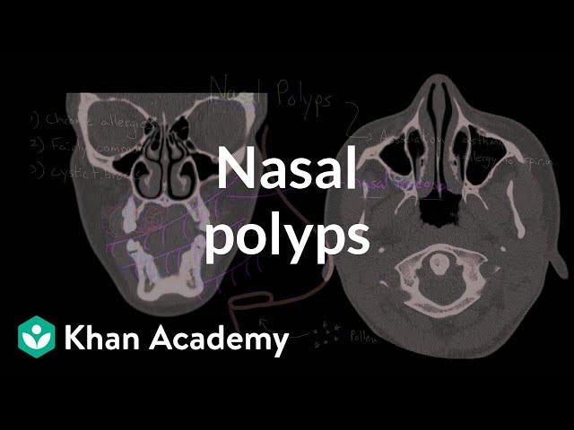 Nasal polyps | Respiratory system diseases | NCLEX-RN | Khan Academy