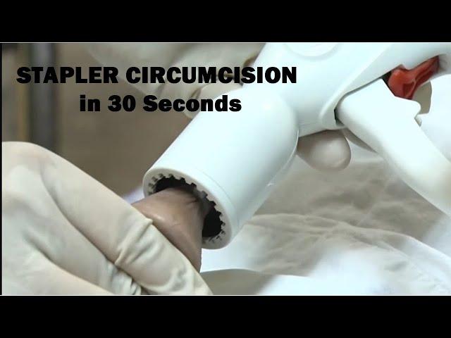 Stapler Circumcision Methods in 30 seconds Video ( Adult Circumcision )