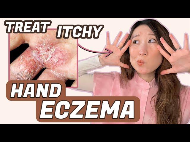 How to Treat Hand Eczema ️ Dr. Joyce Dermatologist