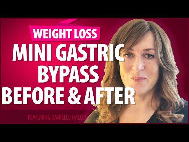 Mini Gastric Bypass Before and After - More Things I Wish I Knew