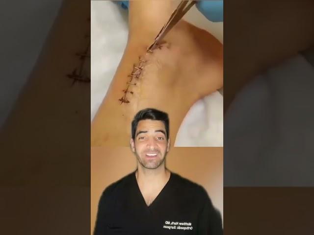 Staple Removal