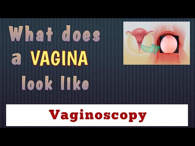 Vaginoscopy