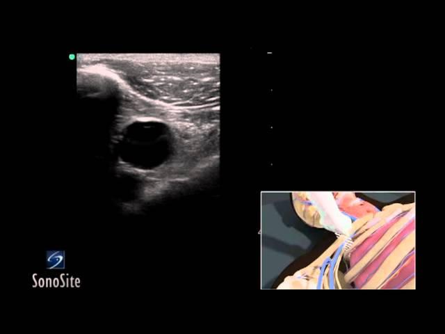 How To: Ultrasound Guided Insertion of a Subclavian Vein Catheter 3D Video