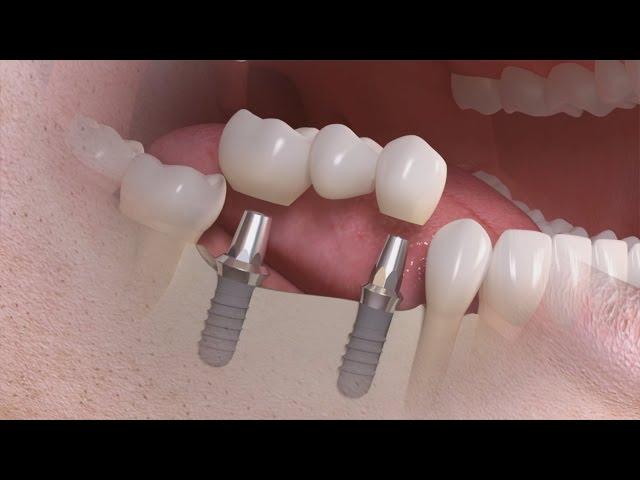 Straumann - Tratamento de vários dentes com solução implanto-suportada