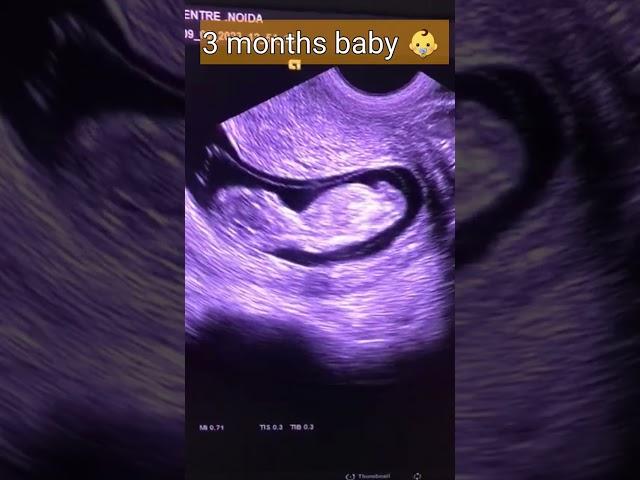 3 months baby on ultrasound/ shortvideo/ shorts