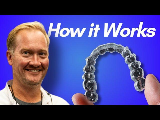 How Invisalign Works in 2024