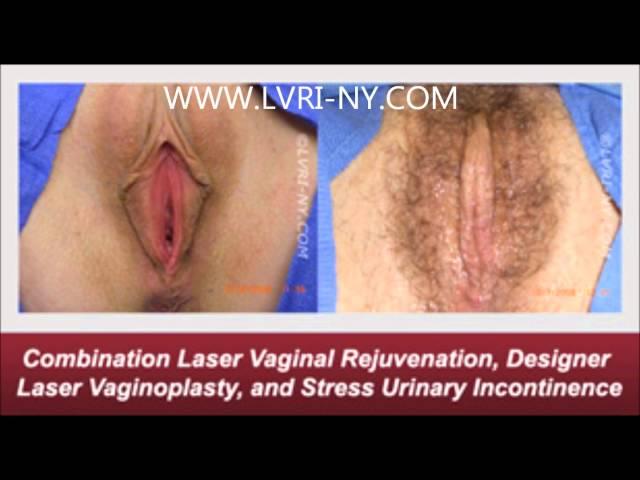 Laser Vaginal Rejuvenation with Stress Urinary Incontinence Before and After Photos | LVRI-NY