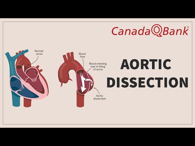 Aortic Dissection