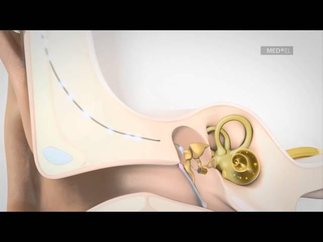 VIBRANT SOUNDBRIDGE Middle Ear Implant System for Hearing Loss Video | MED-EL USA