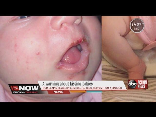 Mom issues a warning about kissing babies