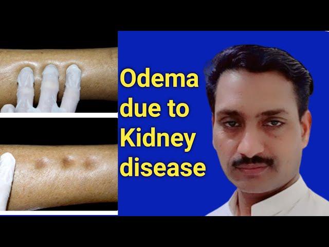 Odema due to Kidney disease || Dr Dilawar Hussain Mughal