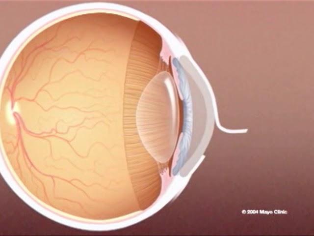 LASIK eye surgery