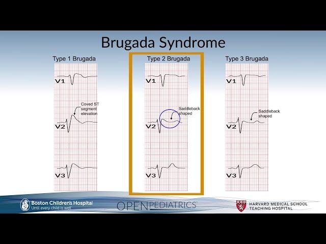 Brugada Syndrome by G. Dhillon | OPENPediatrics