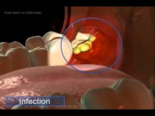 Wisdom Tooth Patient Education 1-Problems