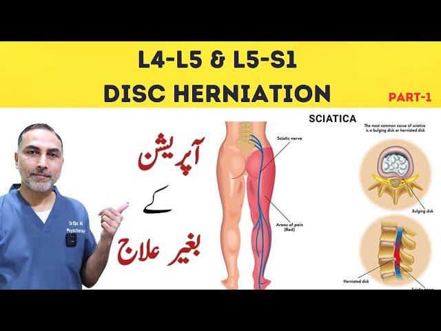 L4 - L5 and L5- S1 Disc Herniation Treatment | Slip Disc Treatment At Home #sciatica