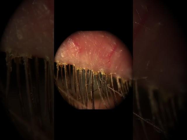 Demodex / Eye Mites