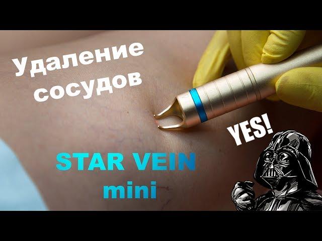 Лазерное удаление сосудистой сетки на аппарате Star Vein mini