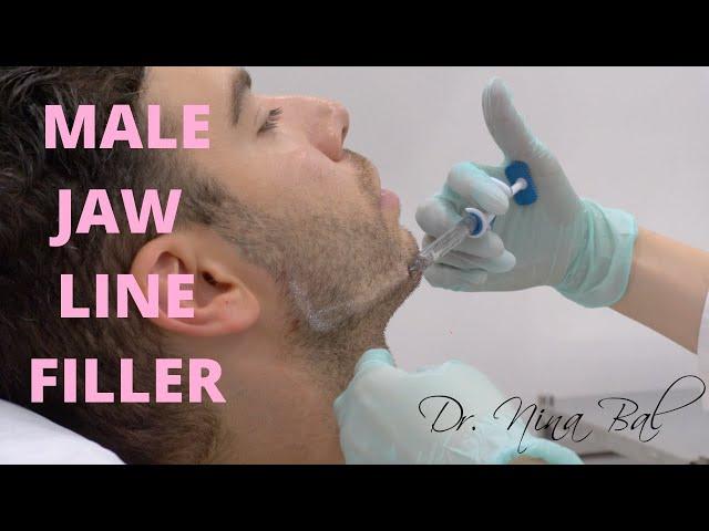  Male Jawline Fillers Before And After  Dr Nina Bal Jawline Transformation