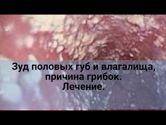 Зуд половых губ и влагалища, причина грибок. Лечение.