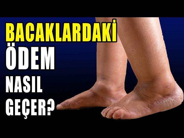 BACAKLARDAKİ ÖDEM NASIL GEÇER? #aktifizyo #ödem #bacakağrısı