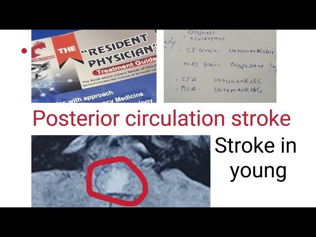 Posterior Circulation stroke "Medullary infarct one of the most dangerous stroke