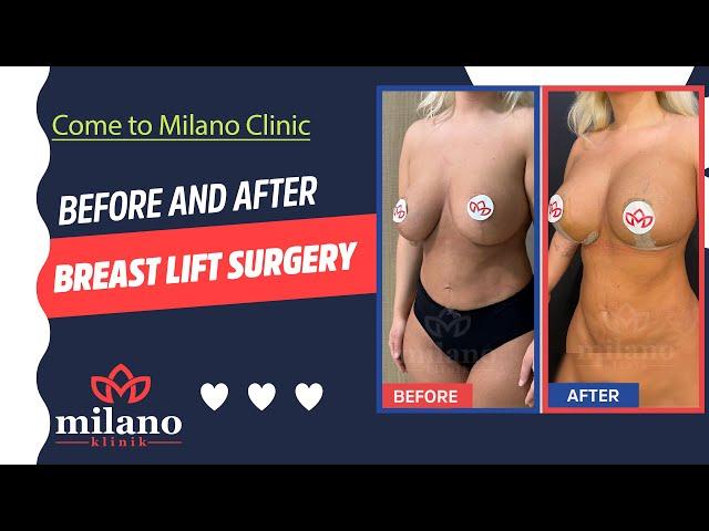 Breast Lift Mastopexy Surgery Before and After in Turkey