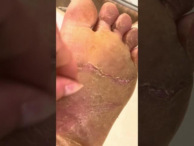 TikTok Compilation - August 2023 - Foot Callus Pedicures EPPK Shaving Scraping Feet Care Satisfying