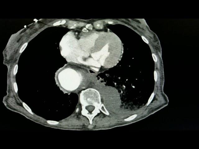 Aortic Aneurysm  CT  JETem 2018