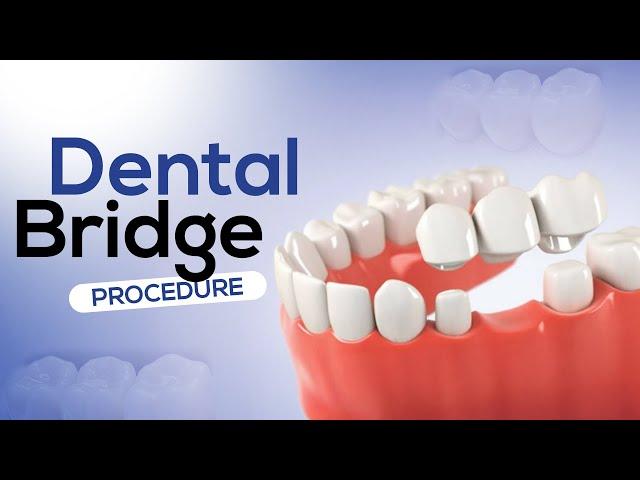 Dental Bridge Procedure 3D Animation