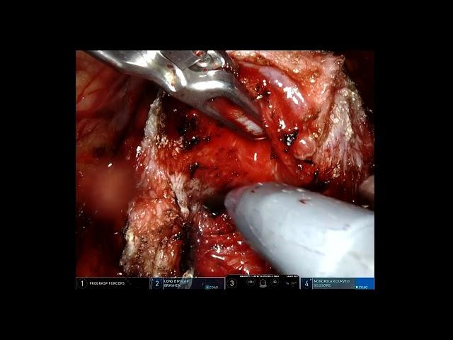 Vipul Patel - Robotic Nerve Sparing Prostatectomy