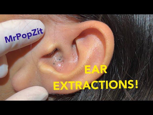 EAR EXTRACTIONS! Must see giant ear blackheads extracted.