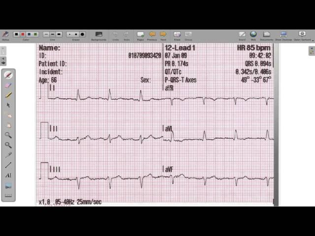 ECG 12 Lead Axis Deviation