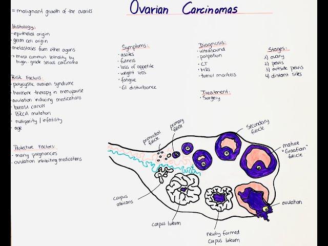 Ovarian Carcinomas - Histology, Types, Symptoms, Diagnosis, Risk Factors, Treatment, Prognosis