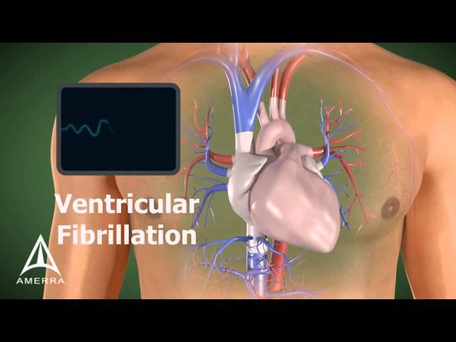 AED - 3D Medical Animation