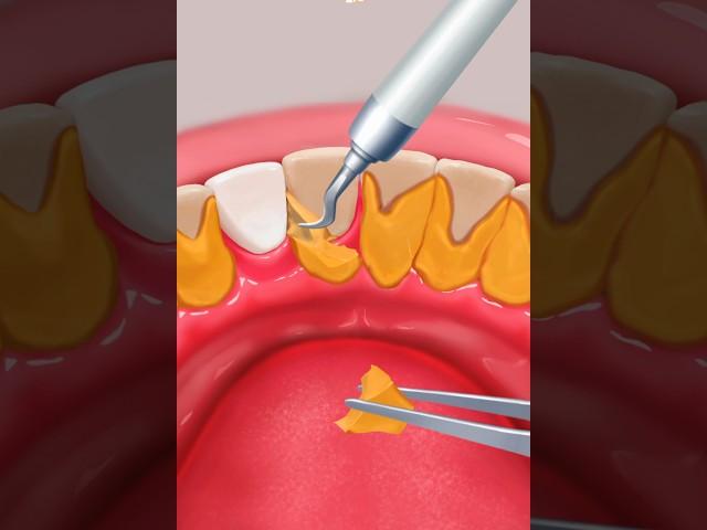 ASMR remove teeth tartar & food stuck clean teeth 2d animation video Habib khan ASMR treatment