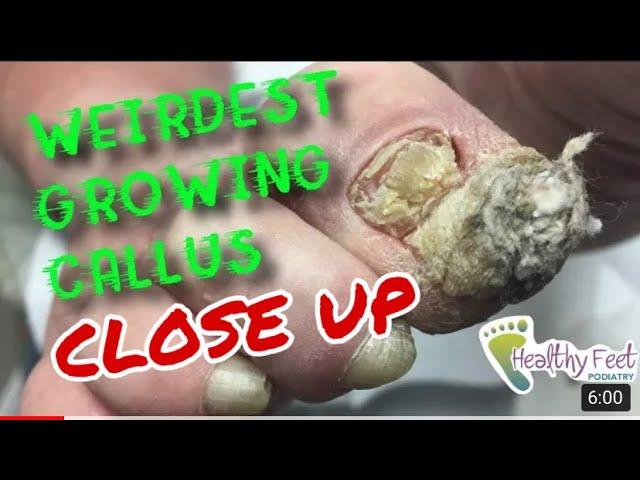 CLOSE UP LOOK at the Weirdest Growing Callus