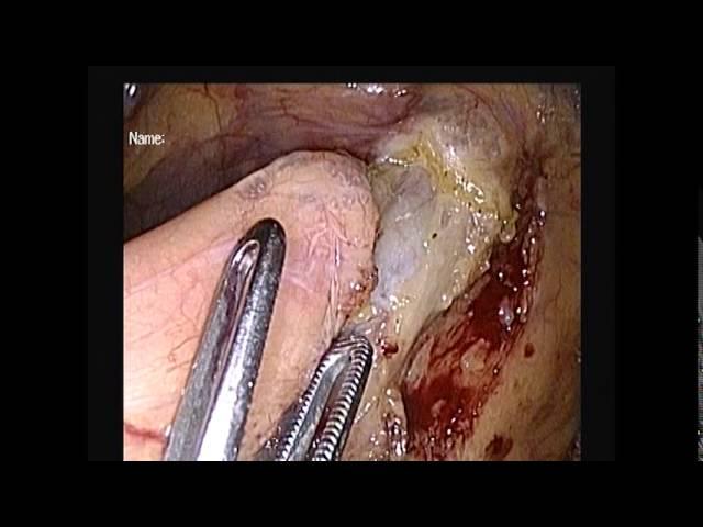 Lap rightcolectomy, BMI=19