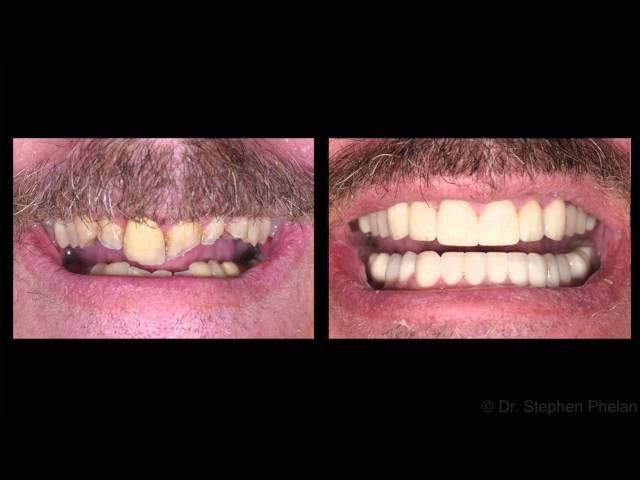 Full Mouth Rehabilitation case study for bite problems by Dr. Stephen Phelan, Oakville, Canada