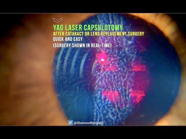 Everything you need to know about YAG LASER Capsulotomy in 30 seconds.