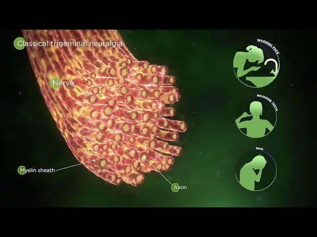 Mechanism of Disease: TN