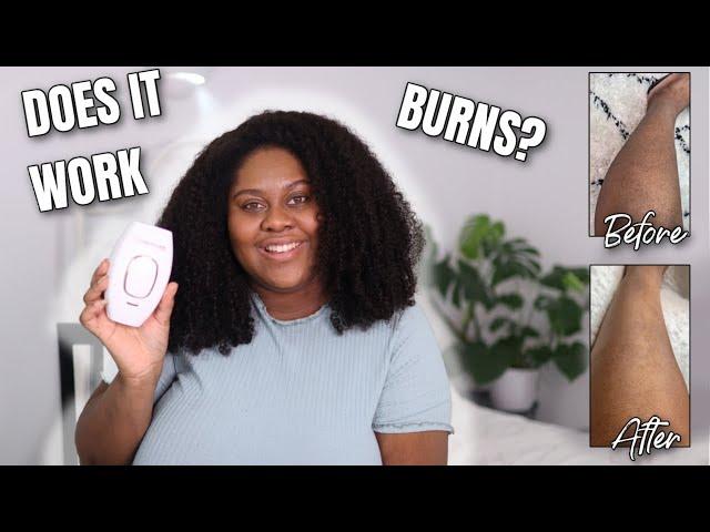 LASER HAIR REMOVAL ON DARK SKIN  4 Weeks Review // RoseSkinCo