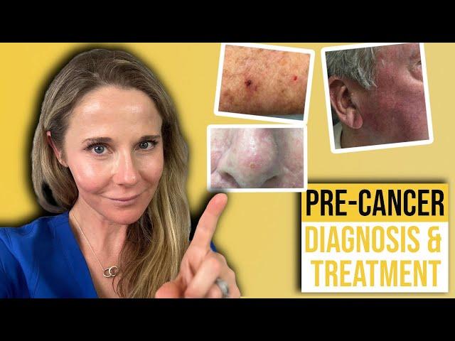 Actinic keratosis treatment guide from a Dermatologist