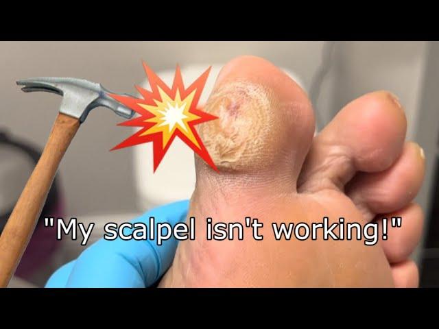 ROCK HARD FOOT CALLUS