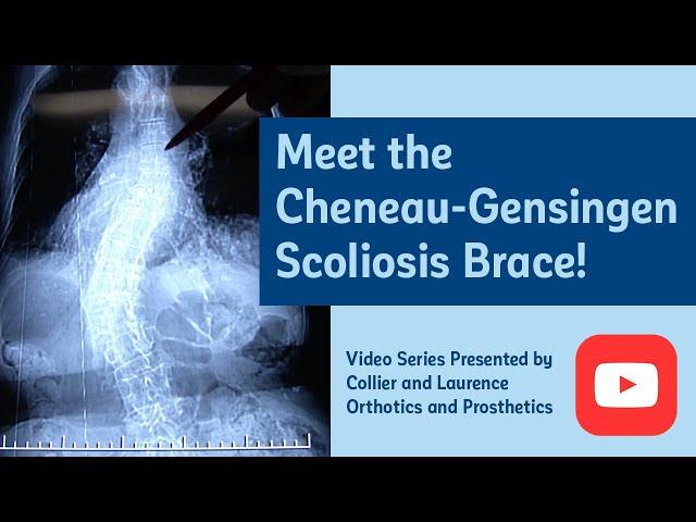 The Cheneau-Gensingen scoliosis brace – A smaller, lighter solution for curve correction.