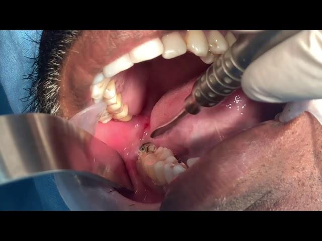 Mesioangular impacted wisdom tooth removal - Third molar extraction under local anesthesia video