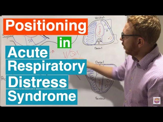 Prone Positioning in Severe ARDS